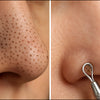 Blackheads Remove Kaise Karein
