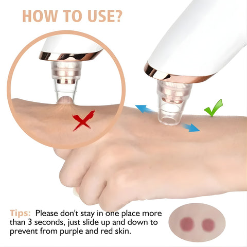 5-in-1 Electric Blackhead Remover Vacuum – Deep Pore Cleaner